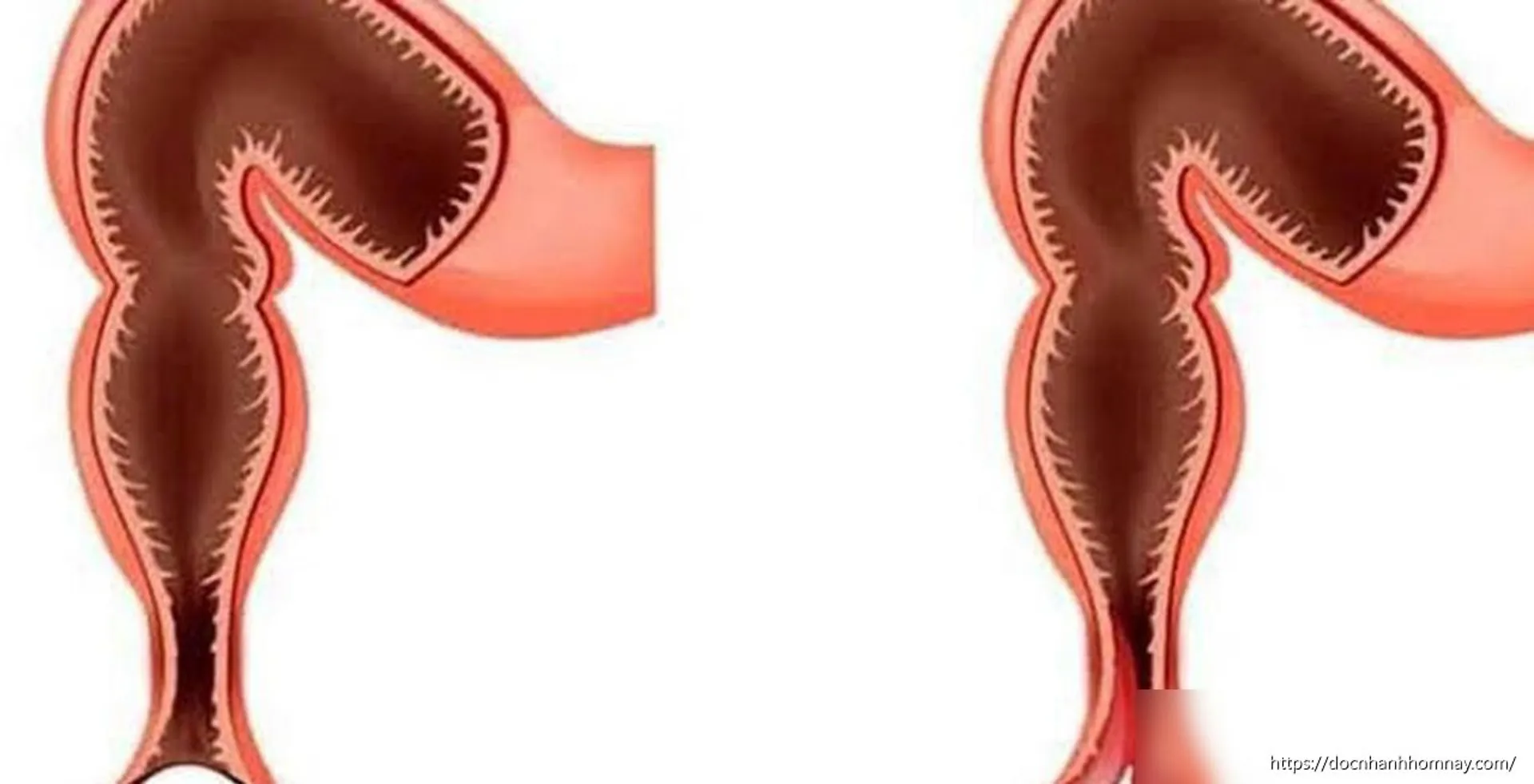 Sa trực tràng ở trẻ em: Nguy hiểm hay không?
